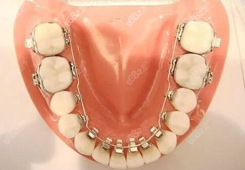 为什么舌侧隐形矫正牙齿价格贵