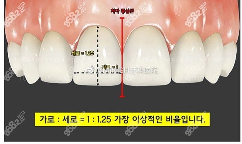 韩国minish牙科医院贴面设计比例