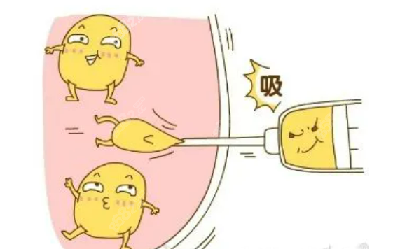 面部吸脂手术