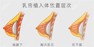 张晨医生在假体隆胸方面的技术优势2