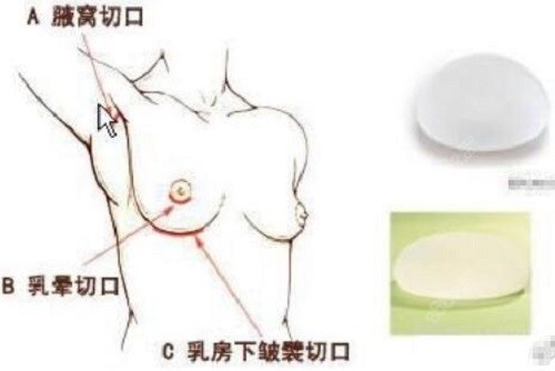 唐毅隆胸失败修复采用乳晕切口