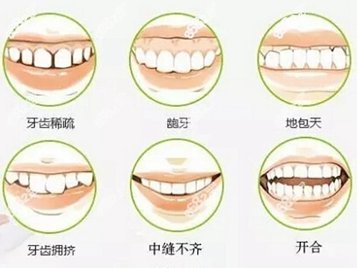 惠州牙齿矫正类型