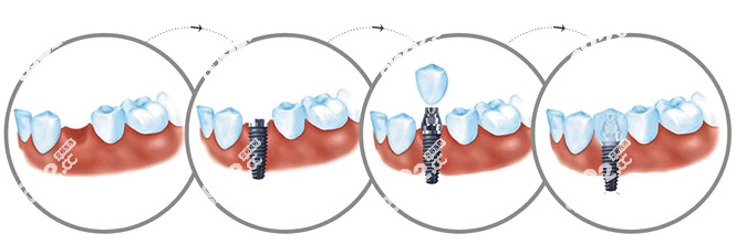 种植牙流程