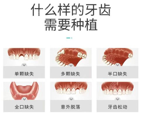 <!--<i data=20240705-sp></i>-->口腔做种植牙的类型图