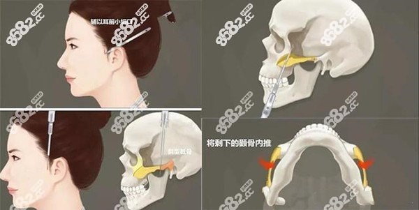 乌鲁木齐颧骨内推价格