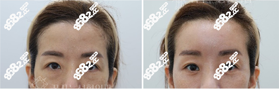 韩国梦美额头填充+眼底脂肪重排术后对比图