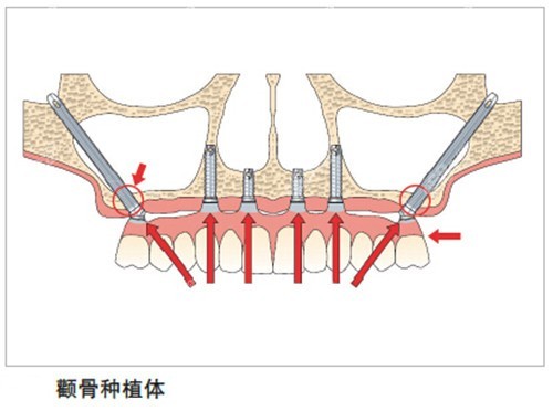 福州福能海峡口腔可做穿颧穿翼种植