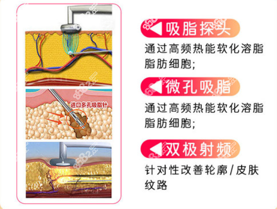 杨德发黄金微雕吸脂技术