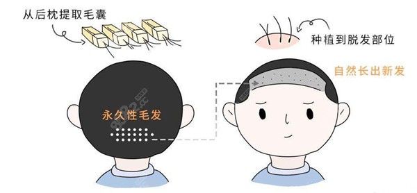 重庆种植头发流程