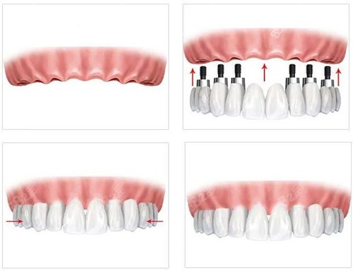 乌鲁木齐满口种植牙价格