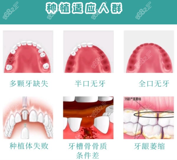 种植牙适合哪些人做