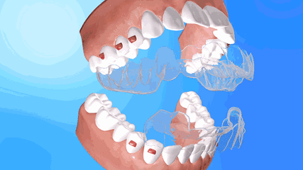 隐形牙齿矫正示意图