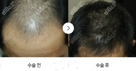 韩国发际线植发例子图片男生