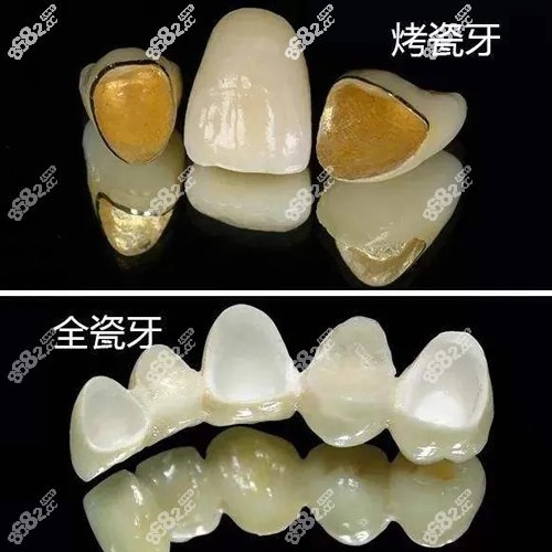 吕梁做烤瓷牙和全瓷牙的价格不等