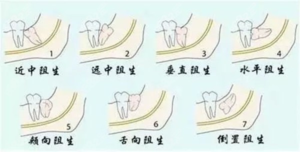 參考2022拔阻生智齒價格表看