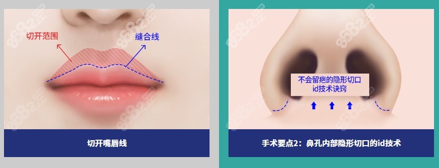 韩国id整形人中缩短手术优势