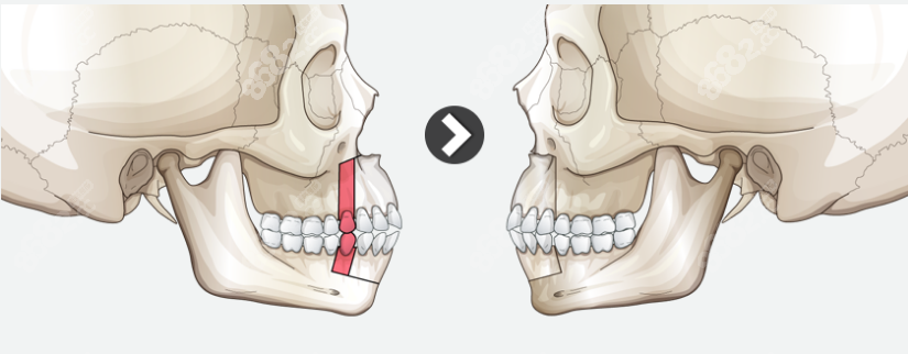 骨性嘴凸矫正手术示意图