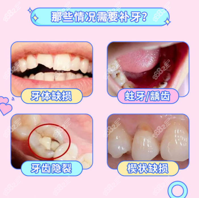 邛崃补牙收费标准