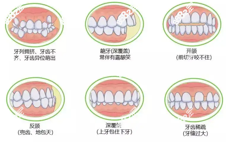 惠州牙齿矫正类型