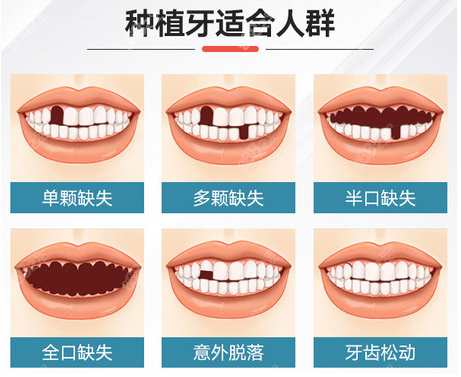 西安林牙立齿口腔做种植牙的类型图