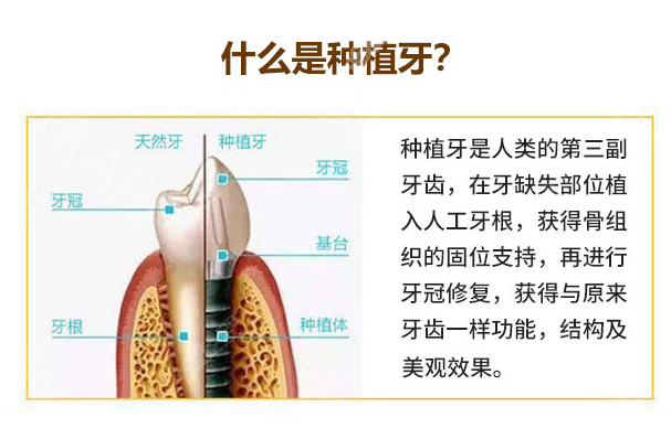 邛崃种植牙多少钱一颗