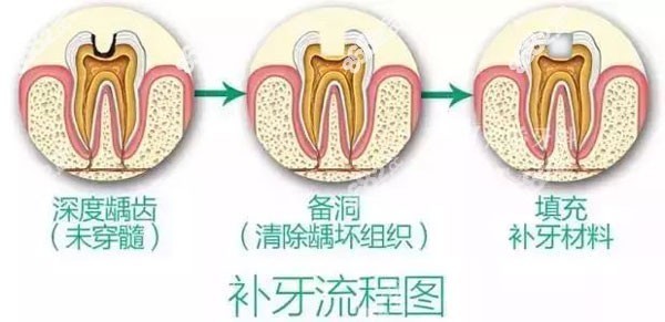 吕梁各口腔医院补牙的流程图