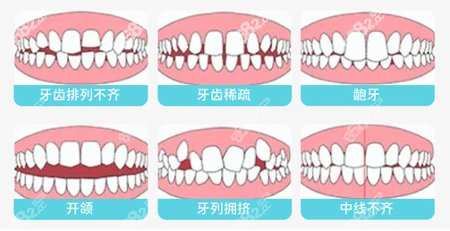 西安林牙立齿口腔做牙齿矫正的类型图