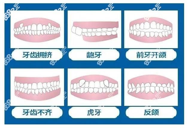 台州儿童地包天正畸价格一般多少钱