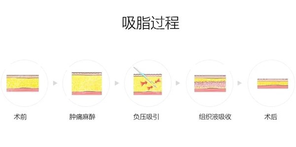 吸脂的过程示意图