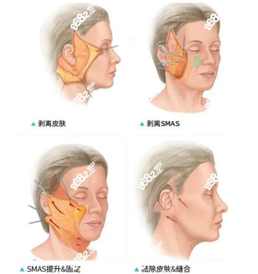 柳民熙拉皮手术做的好吗