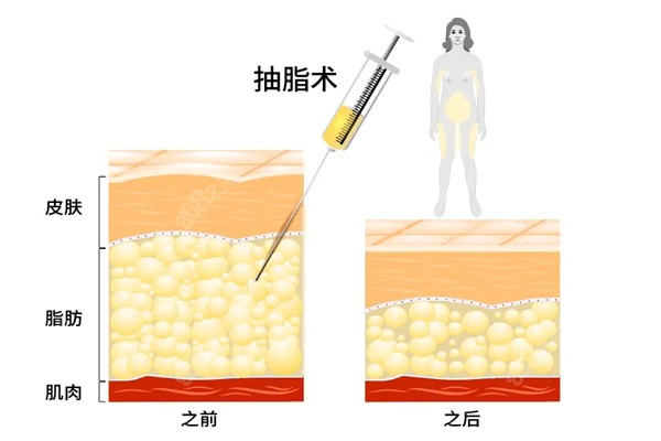 韩国抽脂跟中国吸脂的区别