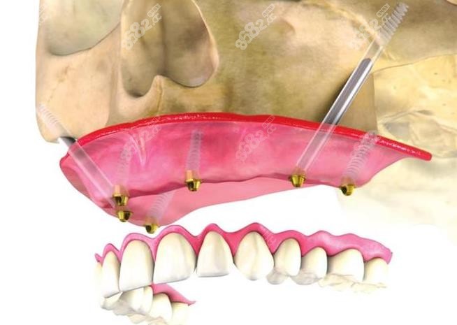 穿颧穿翼种植牙示意图