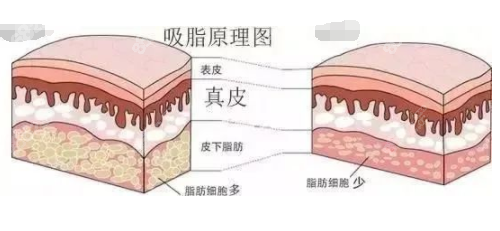 哈尔滨做吸脂好的医院名单