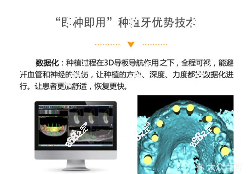 南京卡瓦口腔种植牙优势
