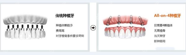 青岛全口种植牙多少钱一颗