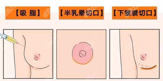 乳房缩小手术的方法