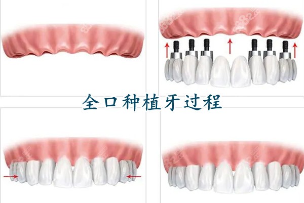 海南全口种植牙价格表