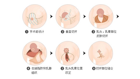 垂直切开法乳房缩小术手术示意图