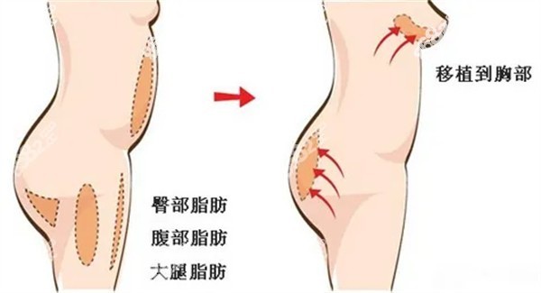 韩国自体脂肪隆胸费用