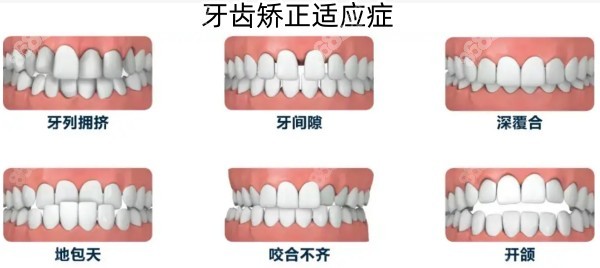 重庆渝中区矫正牙齿多少钱?成人金属牙套/隐形矫正价格不同