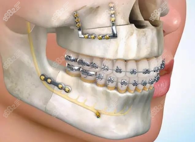正颌手术后需要做正畸的原因