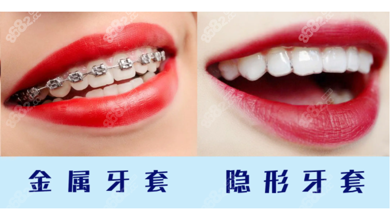 重庆渝中区矫正牙齿多少钱