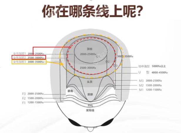 乌鲁木齐植发毛囊数量预测