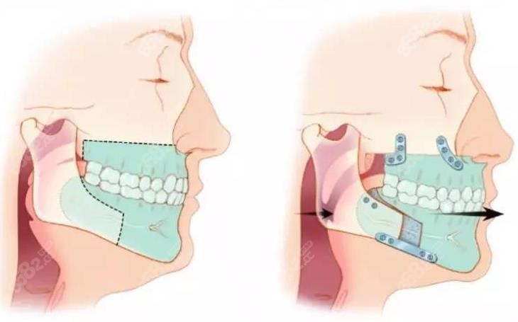 正颌手术示意图