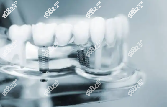 上半口种植牙六颗好还是八颗好