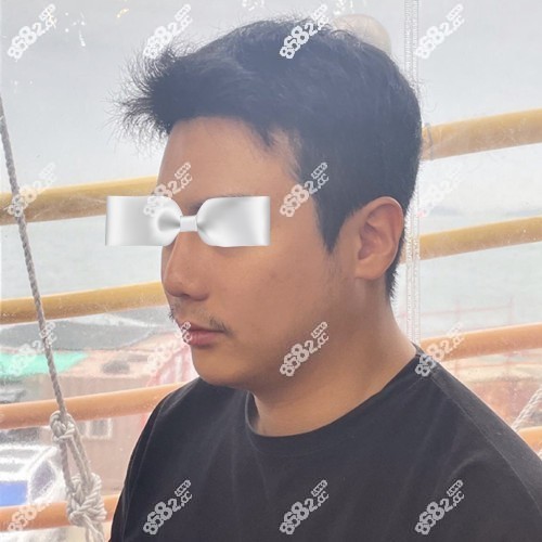 在碧夏整形外科做鼻修复前的样子