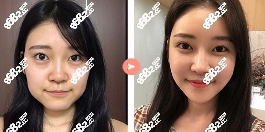 韩国珠儿丽部分切开法眼睛整形前后对比照片