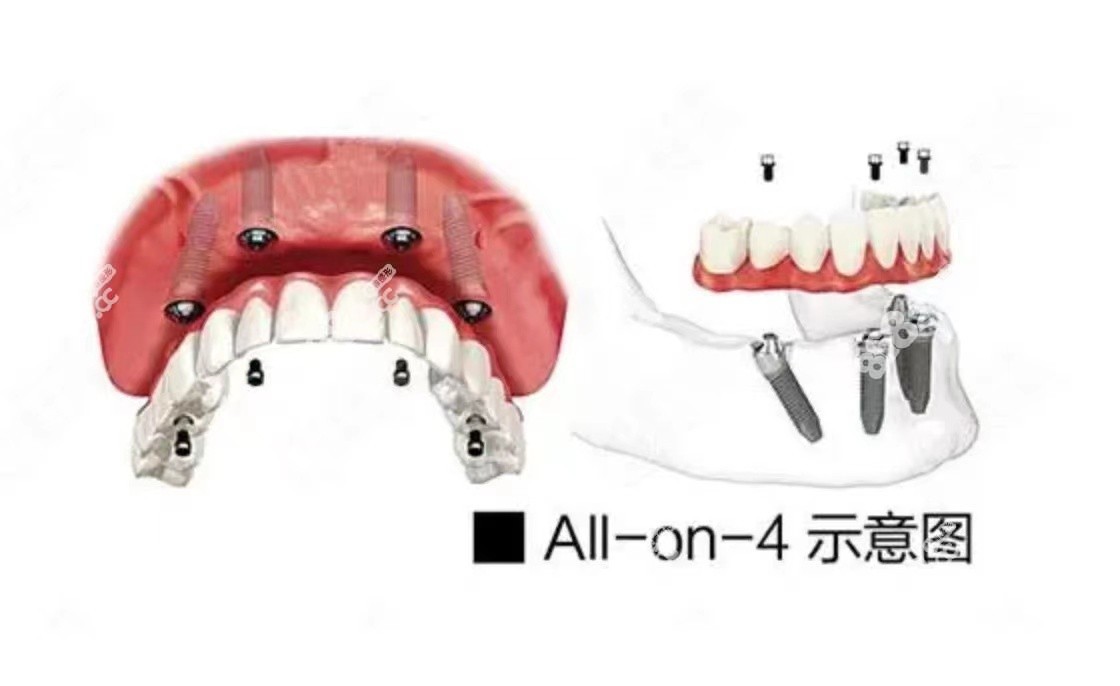 长沙牙祖口腔数字化all-on-4种植牙技术厉害