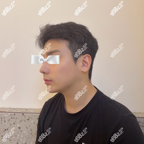 在韩国碧夏整形外科做肋骨鼻修复术后