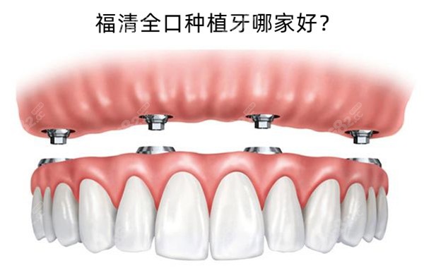 福清全口种植牙医院排名